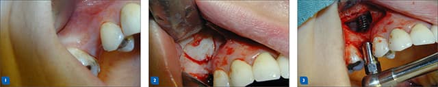 Sinus lift procedure — step 1