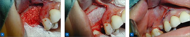 Sinus lift procedure — step 2