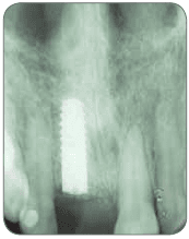 Augmentation of atrophic alveolar ridge