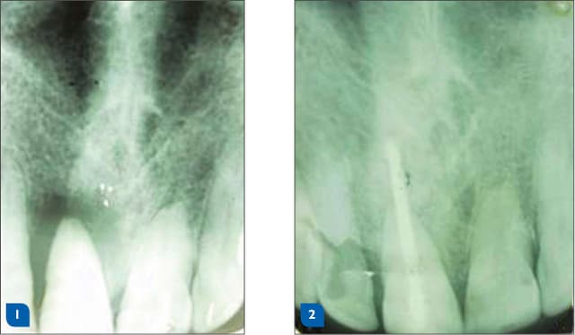 PORESORB-TCP with PRP — periodontal regeneration