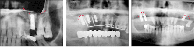 Internal sinus lift — radiograph 1