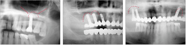 Internal sinus lift — radiograph 2