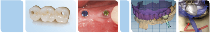 Case report — Dr. Volker Bonatz, Implantologie Journal 3/2021